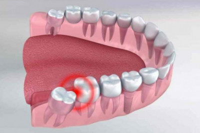 Dental Veneer Treatment Provided by the Cosmetic Dentist