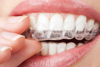 How You Can Treat Your Teeth Treated By Invisalign?