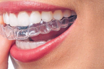 What Do You Mean By Temporary Fillings?