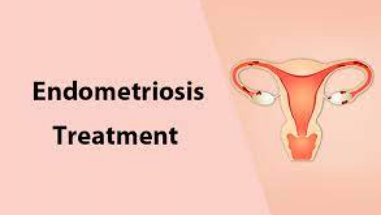 In The Global Endometriosis Treatment Market, Leading Industry Players Are Significantly Accelerating The Development Of Scientific And Clinical Therapeutic Agents