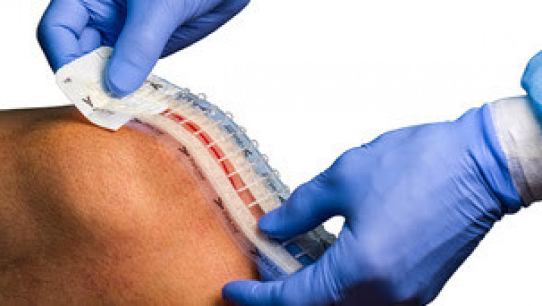 Global Surgical Incision Closure Devices Market 2021: Focusing on Leading Vendors like | Market Analysis and Insights: Global Surgical Incision Closure Devices Market,,