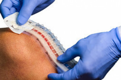 Global Surgical Incision Closure Devices Market 2021: Focusing on Leading Vendors like | Market Analysis and Insights: Global Surgical Incision Closure Devices Market,,