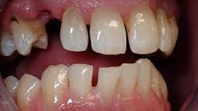 Root Canal Medford Oregon