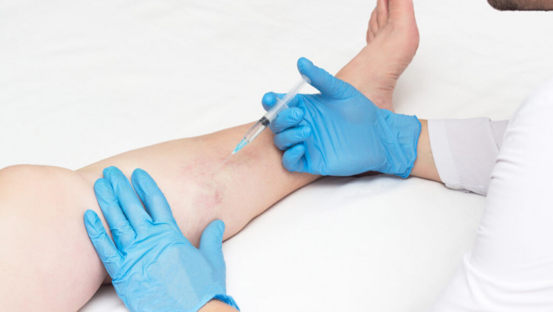 What Is Phlebitis? An Overview: