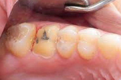 Wisdom Tooth Extraction - 8 Tips for Fast Relief from Post-Procedure Pain