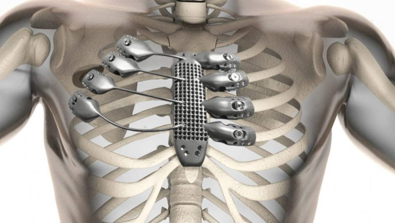 3D Printed Medical Devices Market to Grow at a CAGR of 10% During the Forecast Period 2020-2025