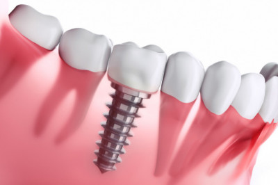 Dental Implant treatment in Kolkata