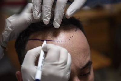 Provisions to take After Hair Restoration in winters