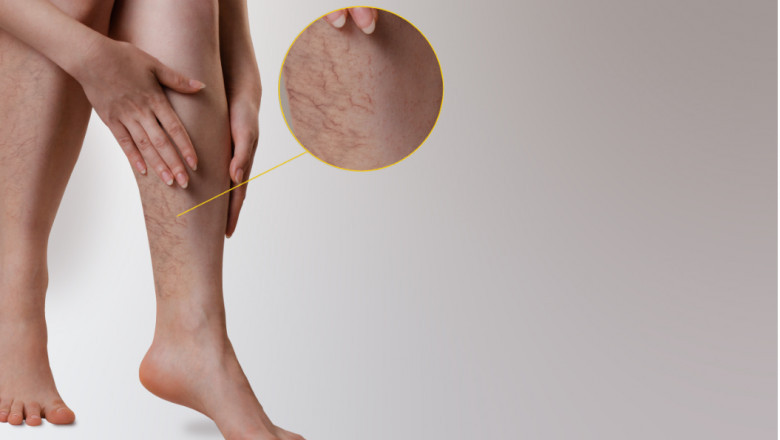 When Should You Visit A Vein Specialist?