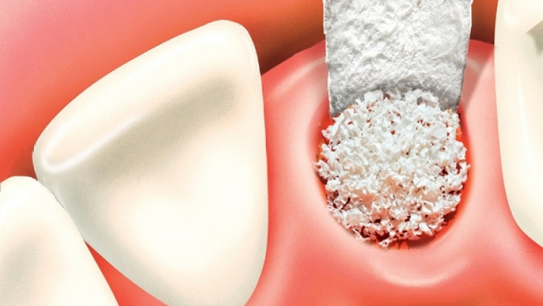 U.S. Dental Membrane and Bone Graft Substitutes Market (Product: Dental Membranes [Resorbable and Non-resorbable]