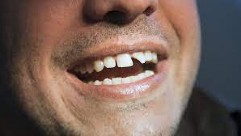 What are the Options Available to Treat a Broken Wisdom Tooth?