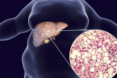 Hoe bestrijd je effectief ‘fatty liver disease’?