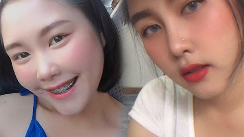 Rhinoplasty: What You may need to know