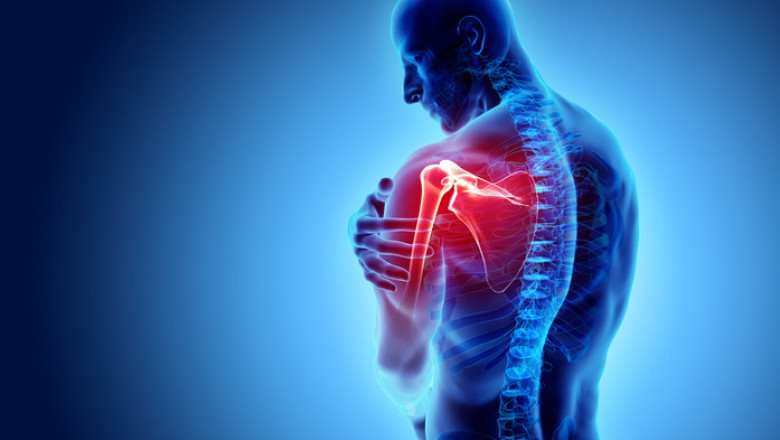 Can frozen shoulder be the symptom of arthritis?