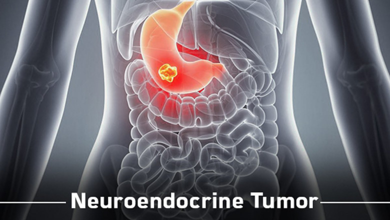 Development of new drugs is expected to boost the neuroendocrine tumor treatment market growth