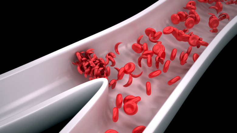 How gene therapy for Sickle Cell Anemia Therapeutics works