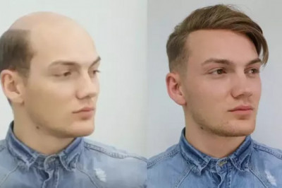 What Happens if You Go Through an FUE Hair Transplant Very Early?