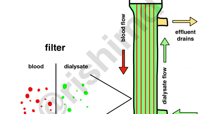 What happens to my blood throughout the Hemodialysis filtering process?