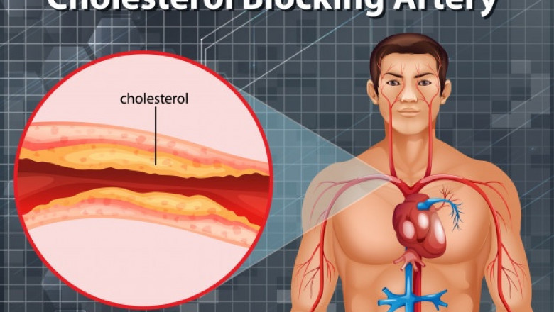 High Cholesterol Facts