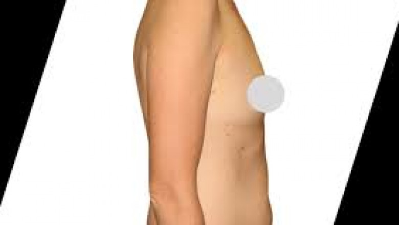 Why Is Mommy Makeover Important After Post-Pregnancy?