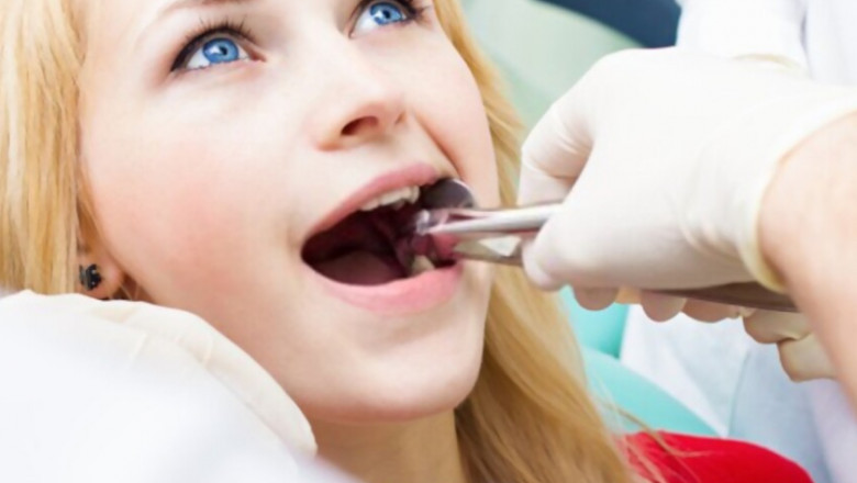 5 Reasons To Go For Tooth Extraction