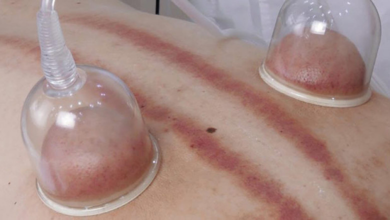 Benefits of Vacuum Therapy Machines