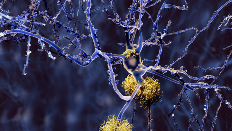 Tips for managing everyday life in Alzheimer's Disease |webhealth