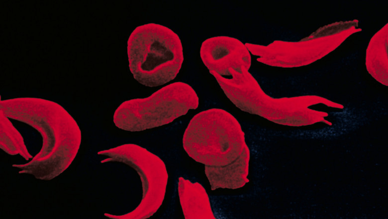 Global Hemoglobinopathy Market Size, Share & Trends Analysis Report and  Forecasts, 2019-2027