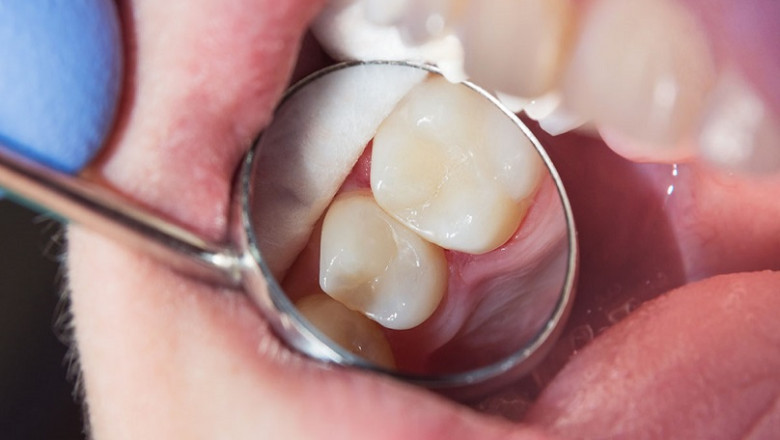 What To Do For An Infected Wisdom Tooth?