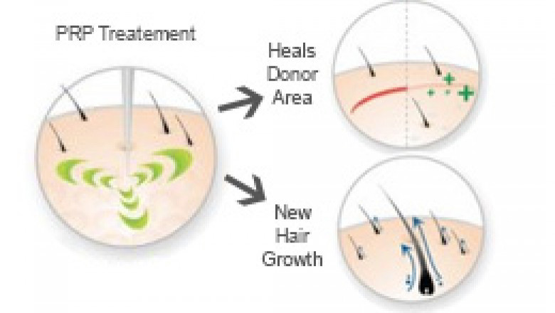 Normal Post PRP Injection Guidelines for Face and Hair