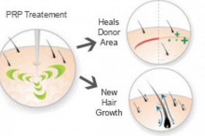 Normal Post PRP Injection Guidelines for Face and Hair