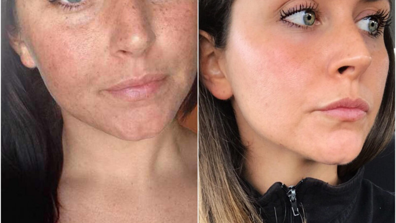Sun Skin Damaged
