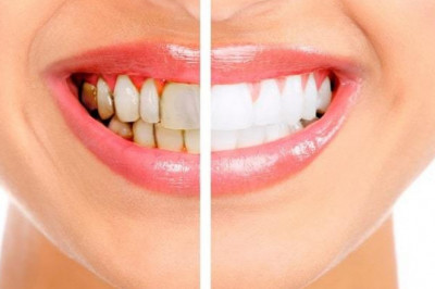 What Are The Pros And Cons Of Porcelain Veneers?