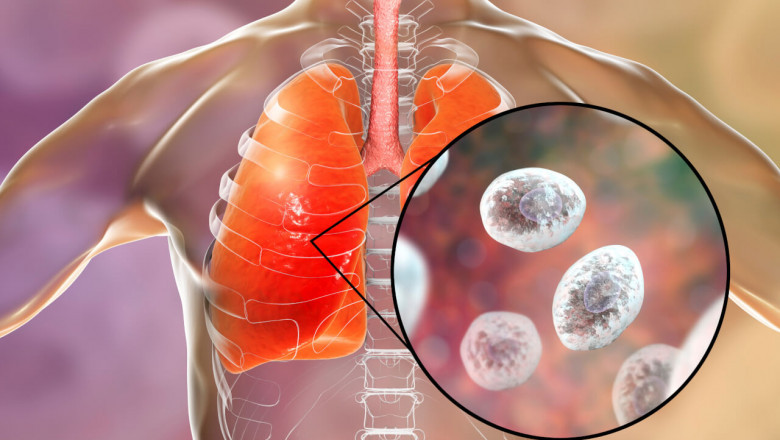 Acute Invasive Aspergillosis Treatment involves the consumption of antifungal drugs and the surgical removal of infected tissues