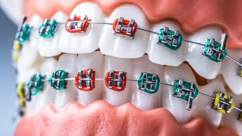 How To Find A Good Orthodontist?