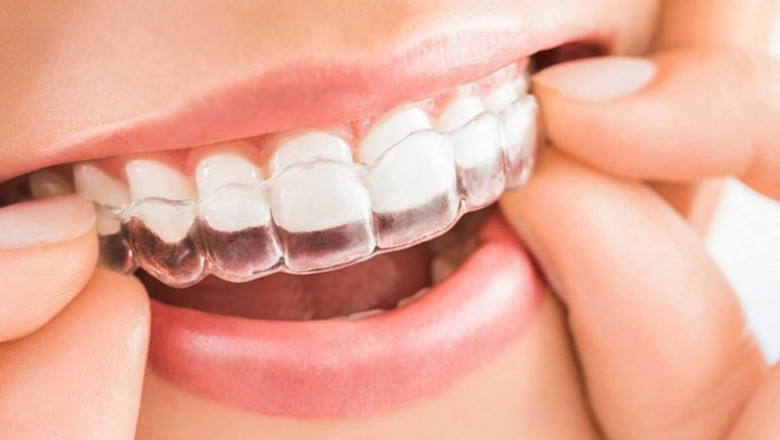 Top Benefits of Using Invisalign Over Traditional Braces