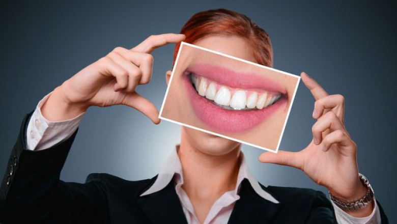 What Are The Most Frequently Asked Questions About Dental Veneers?