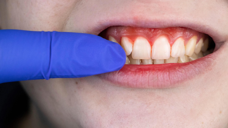 How Long Does It Take To Cure Gingivitis?