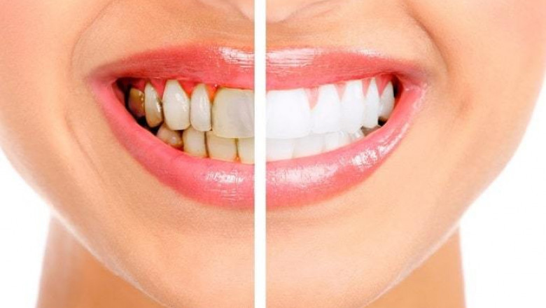 How Do You Know If You Need A Root Canal?