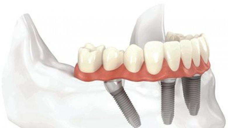 Do I Need a Root Canal?