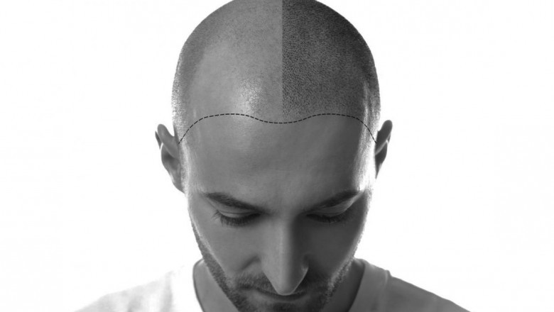 Made Hair Academy: The Most Reliable Place For Hair Loss Treatment