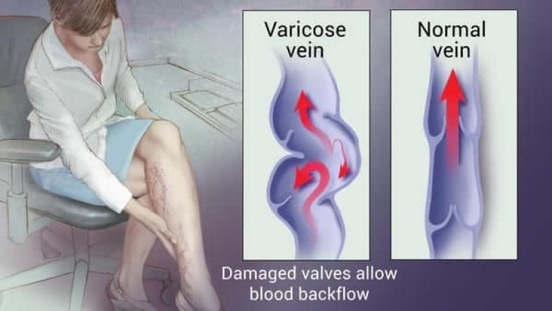 Best Varicose Veins Treatment | Venocare Dubai