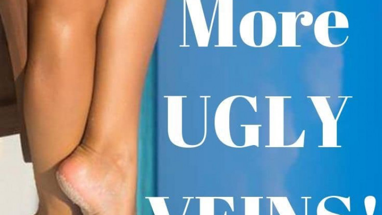 One Stop Clinic For Varicose Veins