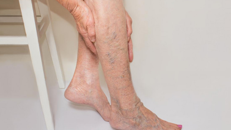 Varicose Veins Treatment Market Global Market Demand, Opportunities, Top Key Players and Forecast to 2027