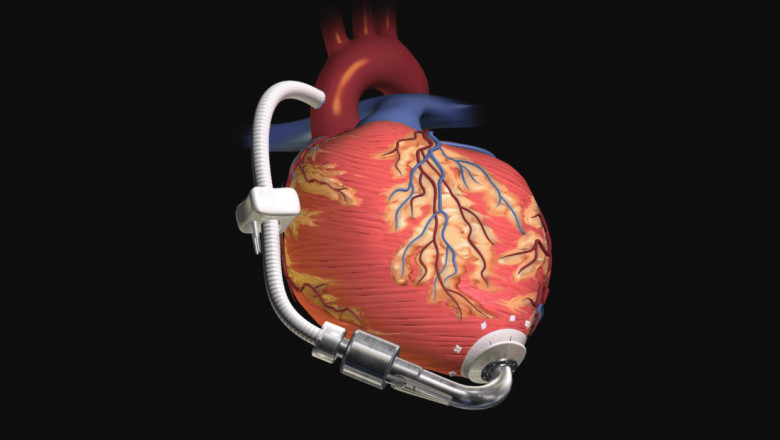 What are the symptoms of Dilated Cardiomyopathy?