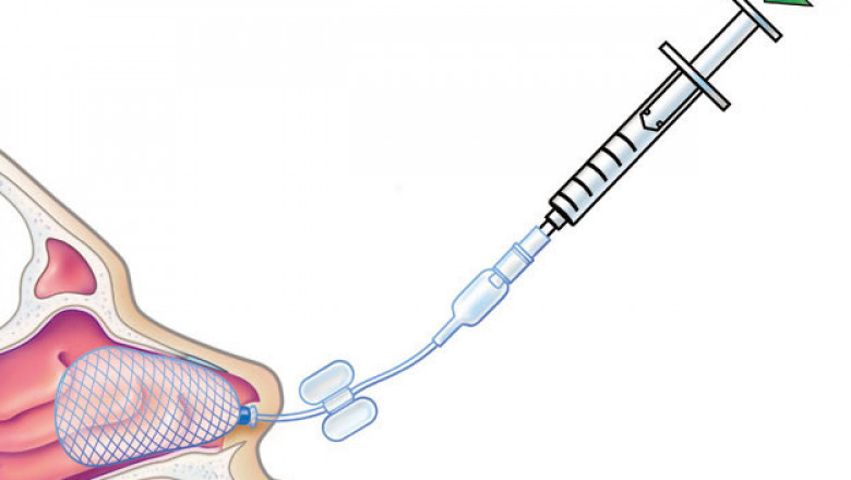What is Epistaxis?