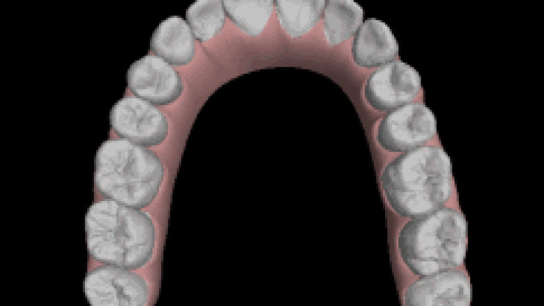 Invisalign Edmonds WA