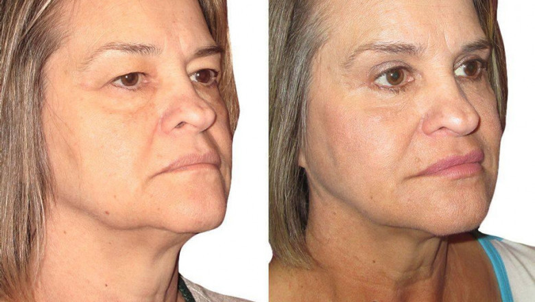 How Much Does an Eyelid Lift Cost?