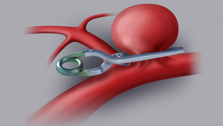 Magnetic Resonance Imaging in Intracranial Aneurysm Clips Patients