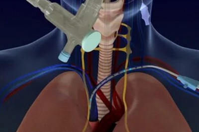 Diaphragm Pacing Therapy System Market worldwide market size and share 2022-2028| Research Informatic